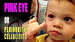 LIVE DIAGNOSIS Pink Eye or Periorbital Cellulitis  Dr Paul [upl. by Nosa]