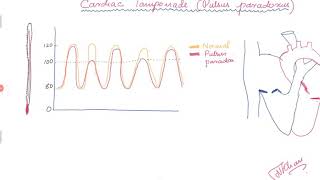 Cardiac Tamponade and Pulsus paradoxus [upl. by Vasquez]