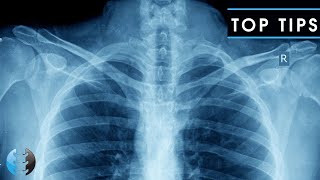 How to Read and Interpret Chest XRays OUR TOP 10 TIPS [upl. by Esile]