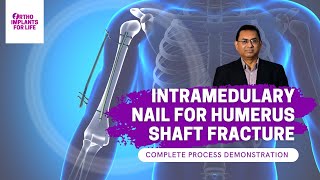 Intramedullary Nail For Humerus Shaft Fracture Procedure [upl. by Amesari797]