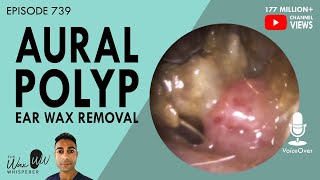 739  Infected Aural Polyp Ear Wax Removal [upl. by Nitnert]