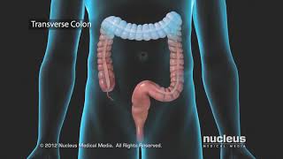 Colon Problems Diverticular Disease [upl. by Davilman]