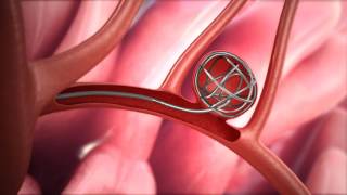 Aspiration Thrombectomy Clinical Evidence [upl. by Bak]