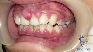 Severe gingivitis amp gingival hyperplasia [upl. by Ayenat]