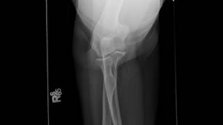 Radial Head Fracture [upl. by Ruhnke]