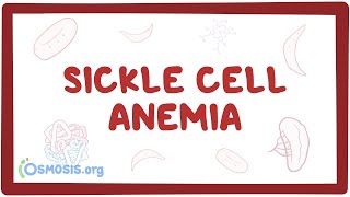 Sickle cell anemia  causes symptoms diagnosis treatment amp pathology [upl. by Eserrehs]