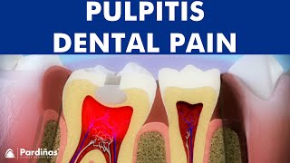 Pulpitis  Inflammation of tooth pulp © [upl. by Brandais48]