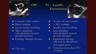 Lambls excrescences [upl. by Peedus]