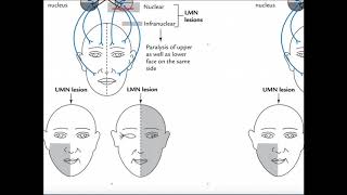 Mechanism of Facial Bells Palsy and Clinical Interpretation [upl. by Gittle604]