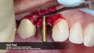 Onestage surgery using Tapered Internal PLUS dental implant from BioHorizons [upl. by Behrens]