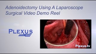 Nasal Polyp Removal Surgery [upl. by Wallis]