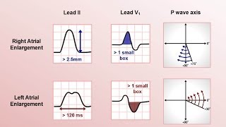 Intro to EKG Interpretation  Chamber Enlargement [upl. by Yim725]