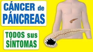 Todos los Síntomas del Cáncer de Páncreas [upl. by Brindell]