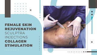 Female Skin Rejuvenation  Sculptra Injections  Collagen Stimulation [upl. by Behah]