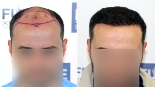 Norwood 5 Hair Transplant  Natural Hair Transplant Towson Maryland  Procedure Jeff [upl. by Romina375]