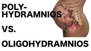 Polyhydramnios vs Oligohydramnios [upl. by Enirhtak]