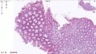 Hyperplastic Polyp  Colon  Histopathology [upl. by King207]