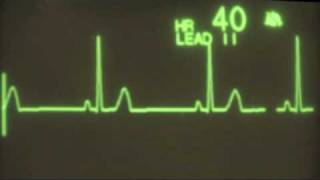 Sinus Bradycardia  ECG Training [upl. by Whiffen696]