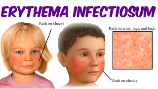 Erythema Infectiosum Fifth Disease [upl. by Enelyt782]