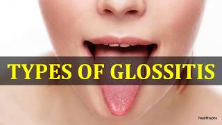 GLOSSITIS [upl. by Neveda]