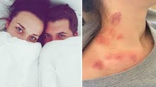 Awesome Ways To Rid Of Love Bites Naturally And Quikly [upl. by Wan]