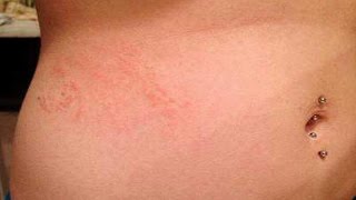 ❄Scabies Rash Images How To Remove Scabies From Hair Scabies After Treatment Scabies Life Cycle [upl. by Eserrehs]