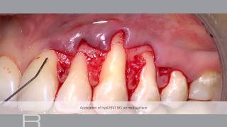 Treatment of gingival recession with a Coronally Advanced Flap by Prof Andrea Pilloni [upl. by Liu]