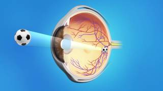 Astigmatism and cataract surgery  proper cataract lens choice [upl. by O'Dell310]