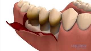 Parodontie par lambeaux  Centres dentaires Lapointe [upl. by Elletnohs]