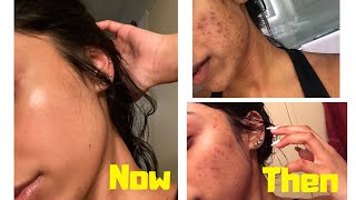 THE ORDINARY SKINCARE  HOW TO GET RID OF DARK SPOTS [upl. by Pia]