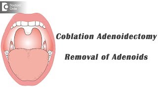 Adenoidectomy [upl. by Nnaacissej694]