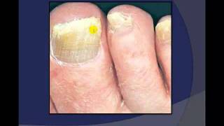 Toenail Debridement by a Podiatrist [upl. by Keli522]