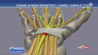 Il mio medico  Tunnel Carpale come curarlo [upl. by Enidlarej]