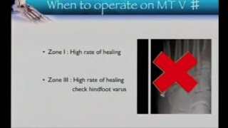 5th Metatarsal fractures [upl. by Florian335]