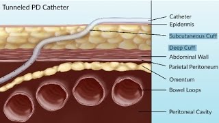 Complications of Peritoneal Dialysis by S Su  OPENPediatrics [upl. by Asiel]