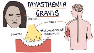 Myasthenia Gravis [upl. by Gaul]