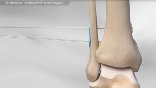 Syndesmosis TightRope® XP Implant System [upl. by Naitsihc]