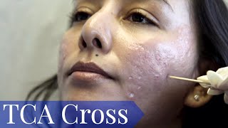 TCA Cross for deep Acne Scars for olive skin tone PART ONE [upl. by Hamlet]