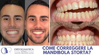 Come correggere la mandibola storta [upl. by Imalda]