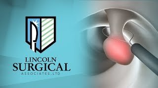 Colon Polyp Removal  Colonoscopy [upl. by Flip]