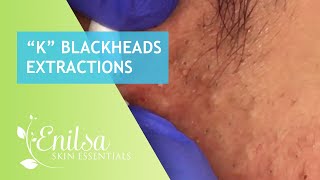 Blackheads Extractions “K’s” 2nd Treatment [upl. by Agueda]