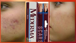 Mederma skin cream review  Scar ointment gel Mederma [upl. by Rolph]