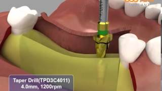 HIOSSEN OSSTEM ETIII System surgical procedures [upl. by Doownel218]