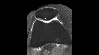 Chondromalacia patella [upl. by Orfinger]