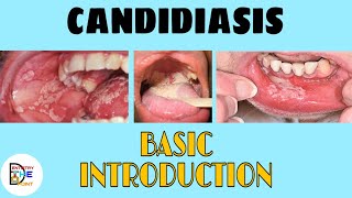 CANDIDIASIS  BASIC INTRODUCTION [upl. by Cordier]