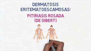 Dermatología  Pitiriasis Rosada de Gibert o de Gilbert [upl. by Sosthina]