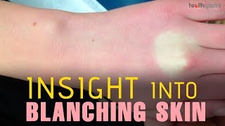 Blanching Skin  Causes Symptoms and Treatment [upl. by Tenrag]