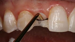 Direct Resin Bonded Bridge  Dental Online Training [upl. by Weidman]