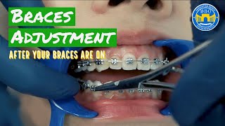 How Do Braces Straighten Teeth [upl. by Ahsim492]