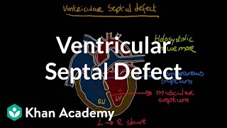 Ventricular septal defect  Circulatory System and Disease  NCLEXRN  Khan Academy [upl. by Atiuqel]